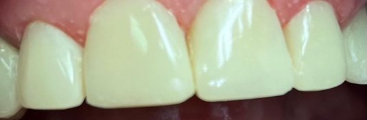 Реставрация зубов в Твери после - пример 1