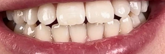 Отбеливание зубов в Твери после - пример 1